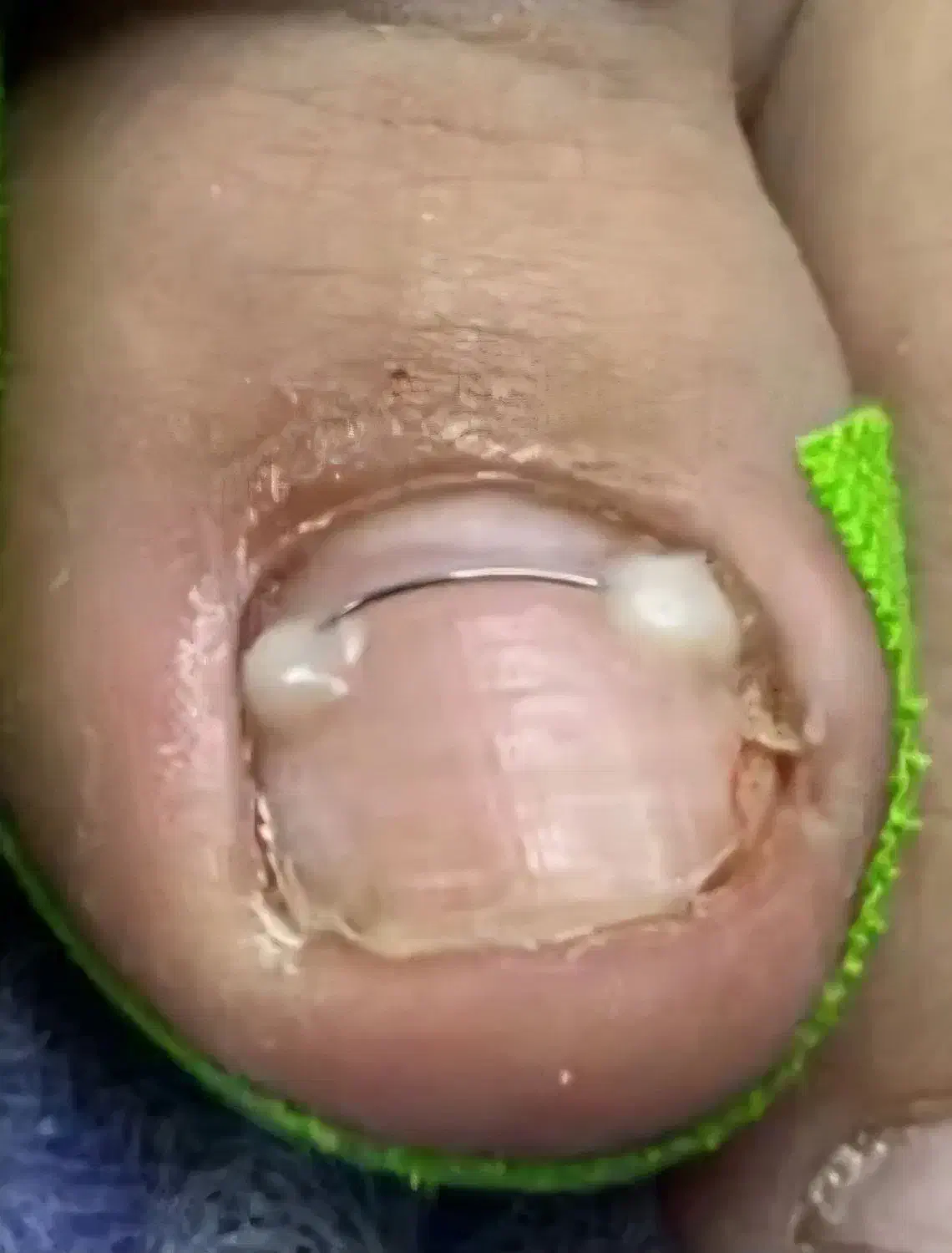 درمان و اصلاح ناخن پا در کلینیک لوتس و منزل|خدمات آرایشگری و زیبایی|تهران, یوسف‌آباد|دیوار