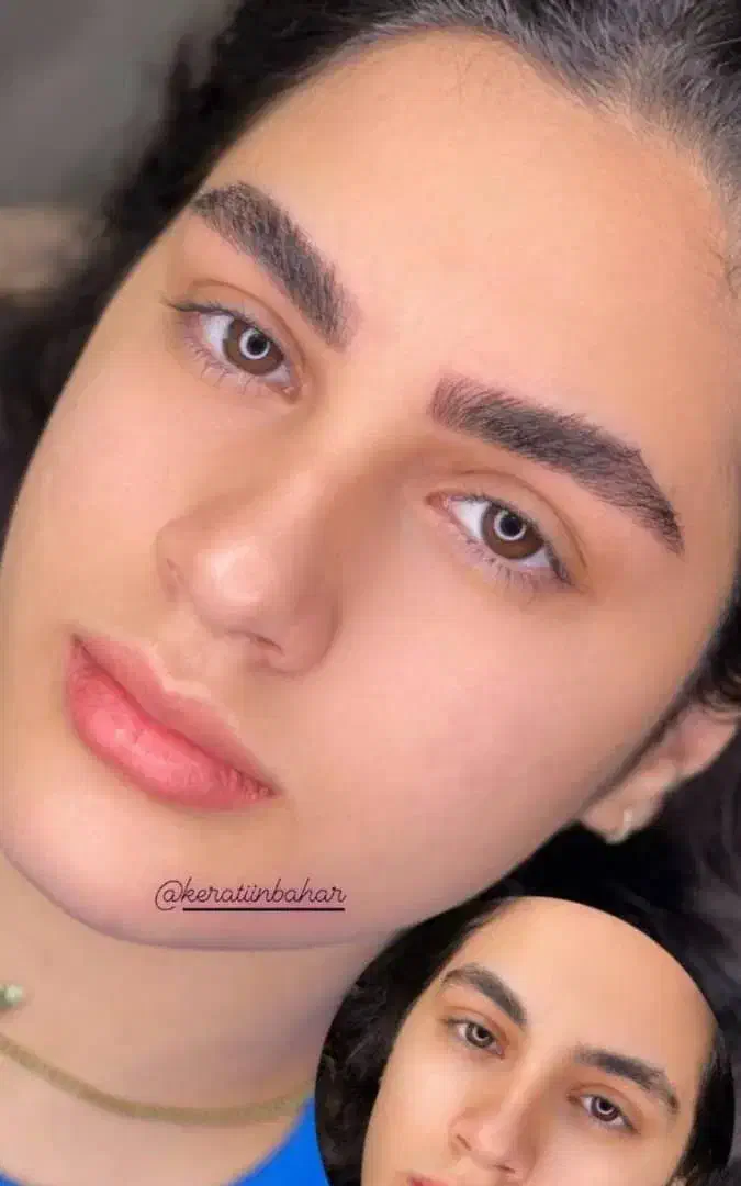 میکروبلیدینگ و فیبروز صورت بدون درد و خونریزی|خدمات آرایشگری و زیبایی|گلبهار, شهر جدید گلبهار|دیوار