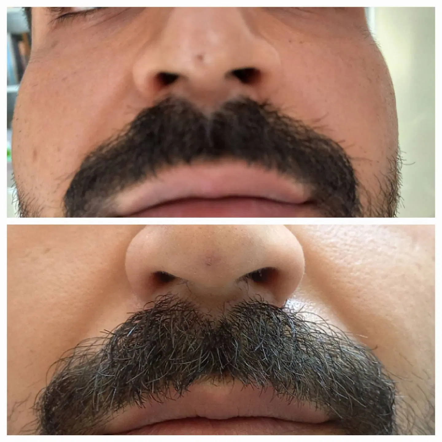 از بین بردن فوری جای جوش/زخم/آکنه/هایفو/Co2|خدمات زیبایی و سلامت|تهران, تجریش|دیوار
