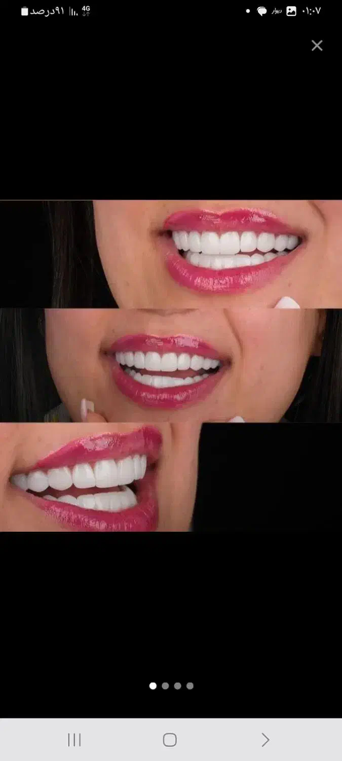 افر ویژه کامپوزیت دندان مواد تضمینی و اصلی|خدمات آرایشگری و زیبایی|کرج, گوهردشت|دیوار