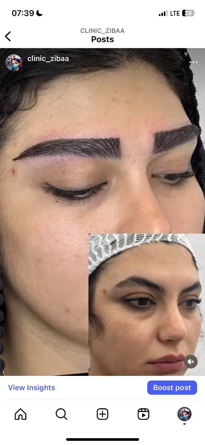 کاشت مو وابرو بدون سیخ سیخ شدن وبهترین خواب|خدمات آرایشگری و زیبایی|مشهد, احمدآباد|دیوار