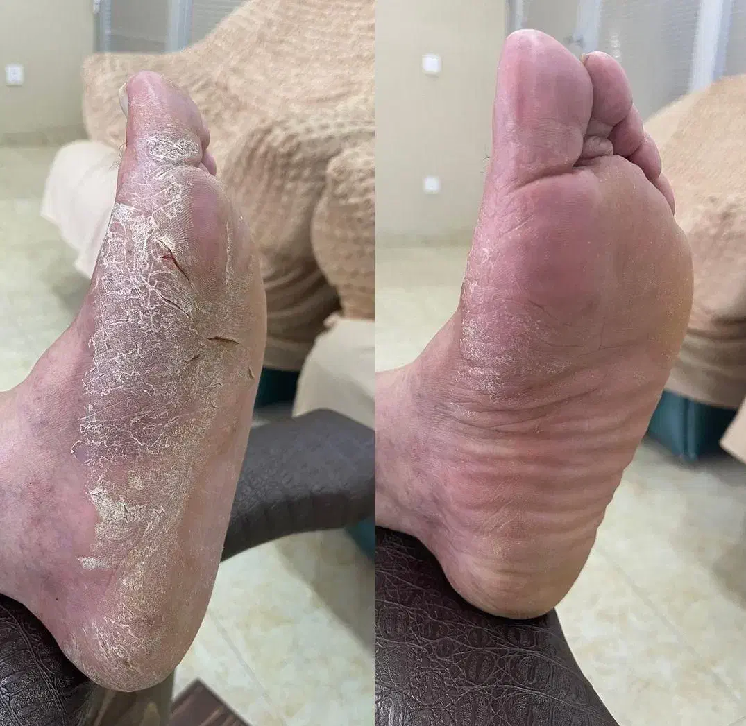 درمان دائمی بیماری پوستی خود ایمنی|خدمات آرایشگری و زیبایی|کوهنجان, |دیوار