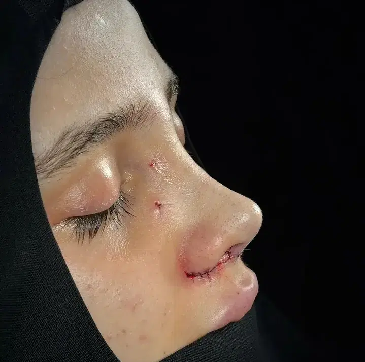 عمل بینی با چک صیادی مشاوره رایگان فوقتخصص ENT|خدمات زیبایی و سلامت|تهران, سهروردی|دیوار