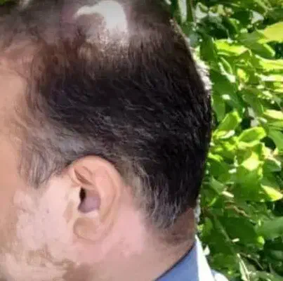 پوست چرب و جای جوش و آکنه|آرایشی، بهداشتی، درمانی|شیراز, لشکری|دیوار