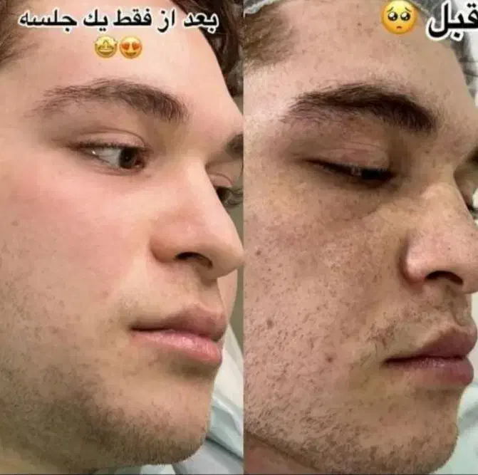 درمان و لیزر تضمینی کک و مک و لک فقط در 1 جلسه|خدمات آرایشگری و زیبایی|اصفهان, لاله|دیوار