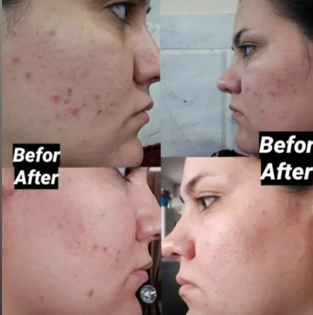 پک ضد جوش|آرایشی، بهداشتی، درمانی|بوئین زهرا, |دیوار