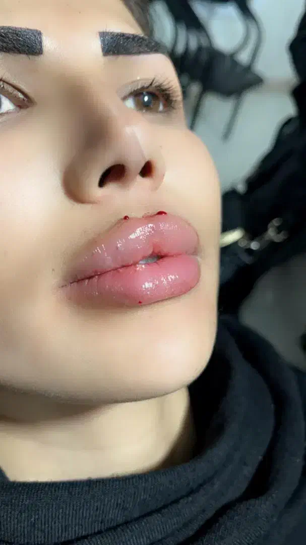 تزریق آموزش ژل بوتاکس چربی|خدمات آرایشگری و زیبایی|صدرا-فارس, فاز ۱|دیوار