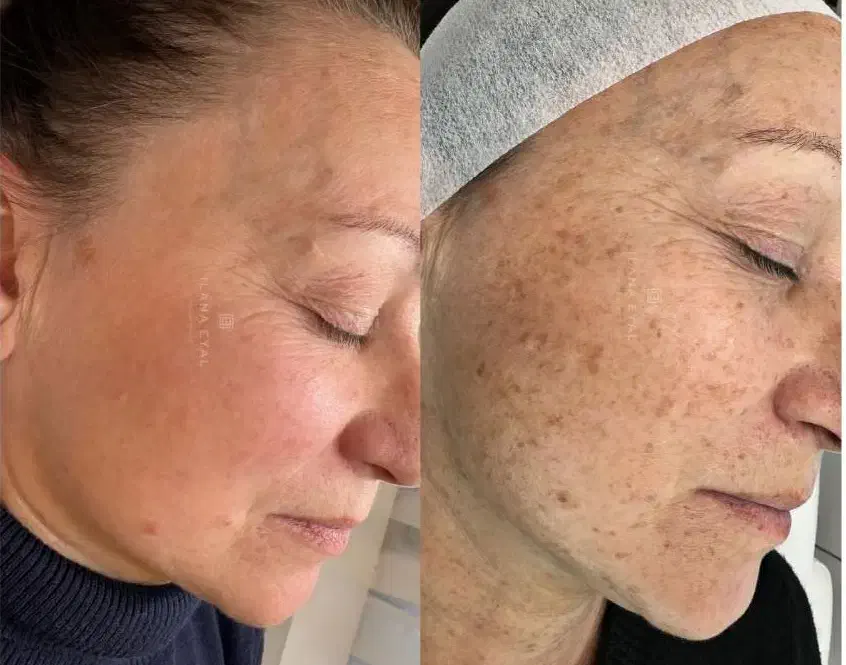 درمان تضمینی لک و کک و مک و خال /فقط در 1 جلسه|خدمات آرایشگری و زیبایی|اصفهان, لاله|دیوار