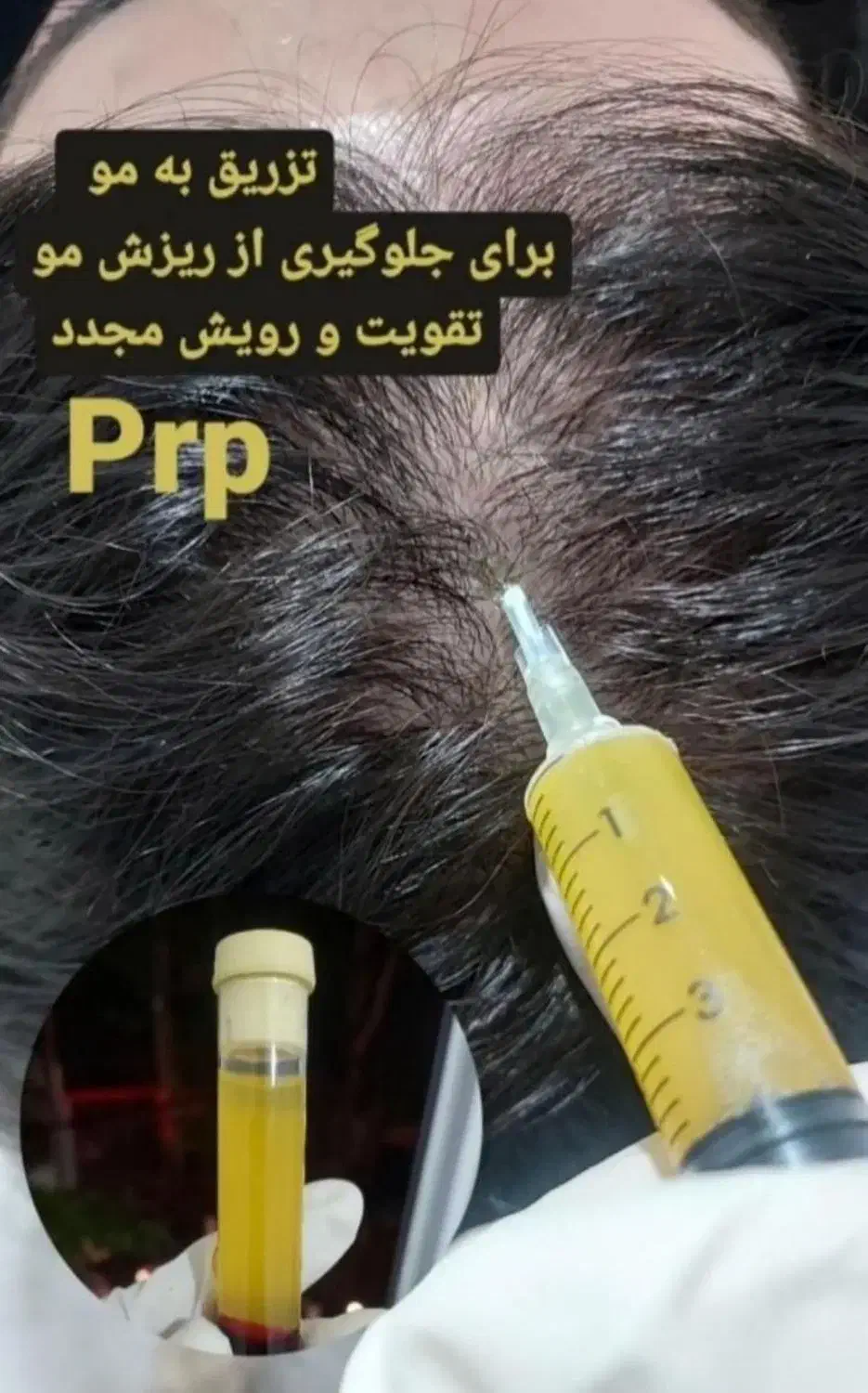 انواع خدمات ژل بوتاکس انزیم تخفیف ویژه|خدمات آرایشگری و زیبایی|کوهدشت, |دیوار