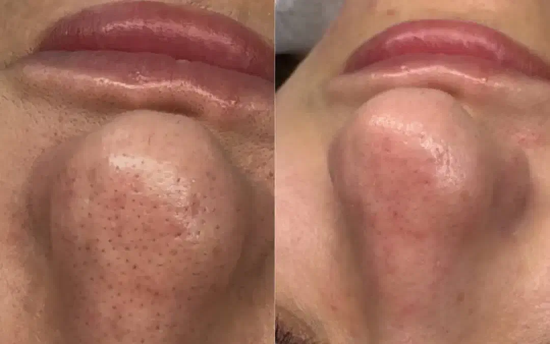 کربوکسی تراپی همراه با فیشال دوتا باهم ۳۵۰|خدمات آرایشگری و زیبایی|دورود, |دیوار