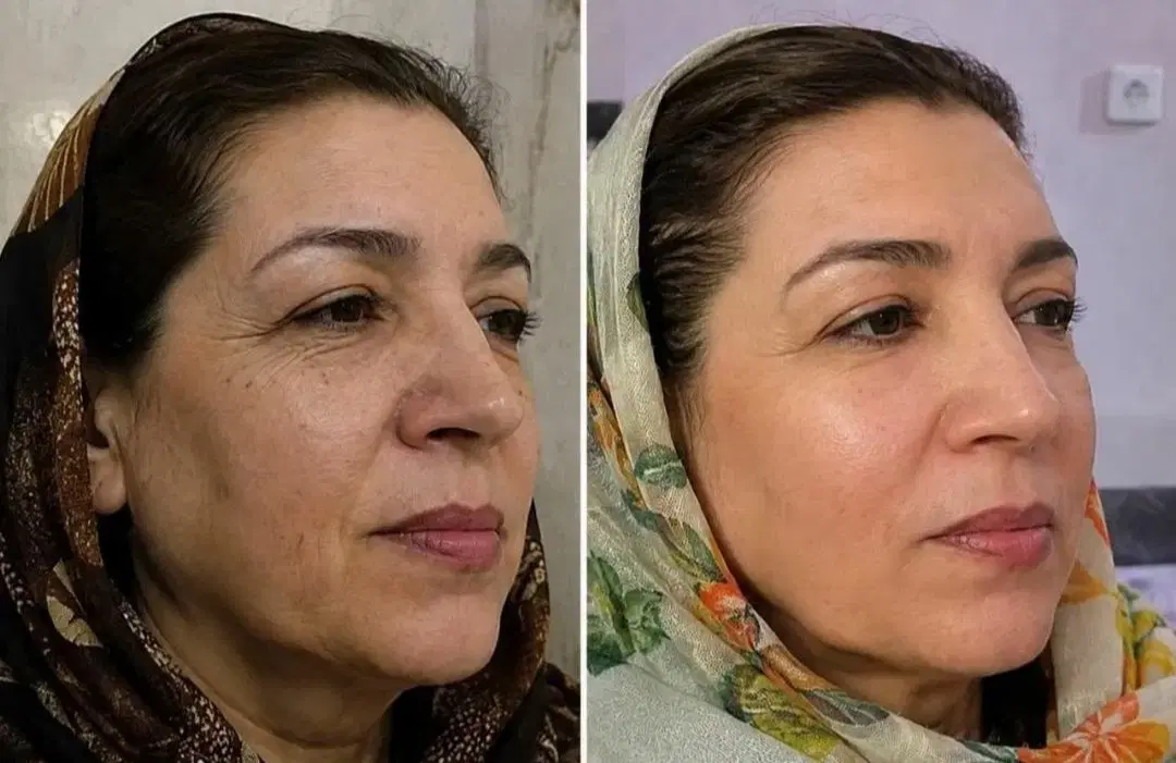 کرم بیوممتیک ۱۵ کاره ضد لک|آرایشی، بهداشتی، درمانی|قم, میدان نو|دیوار