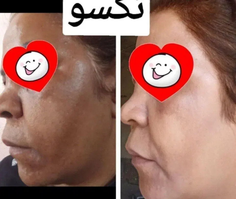 پوستی صاف وشفاف|آرایشی، بهداشتی، درمانی|قم, صفائیه|دیوار