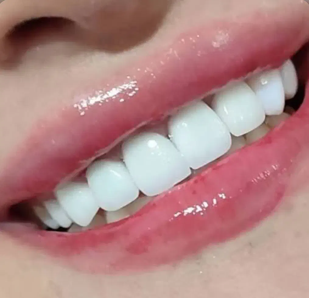 لمینت مترحک دندان اصل|آرایشی، بهداشتی، درمانی|ایلام, |دیوار