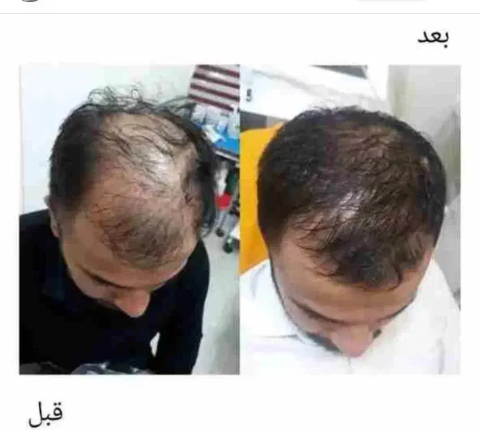 مزوتراپی مو (قطع ریزش)|خدمات آرایشگری و زیبایی|اندیشه, اندیشه فاز ۳|دیوار