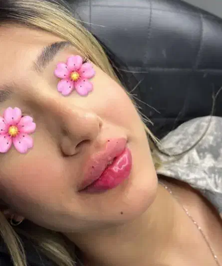 تزریق فیلر(ژل و بوتاکس)|خدمات آرایشگری و زیبایی|خرم‌آباد, |دیوار