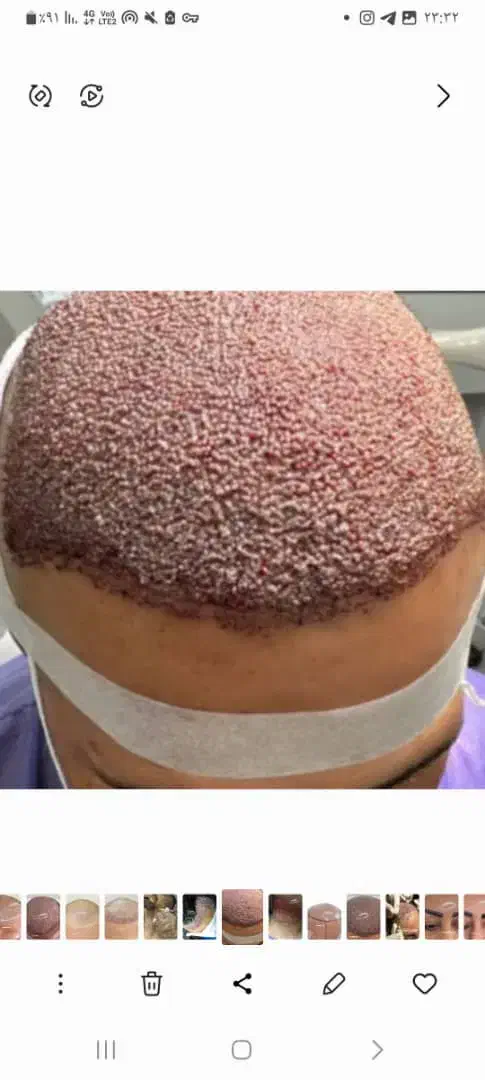 کاشت مو وابروتخصصی|خدمات آرایشگری و زیبایی|خرمشهر, |دیوار