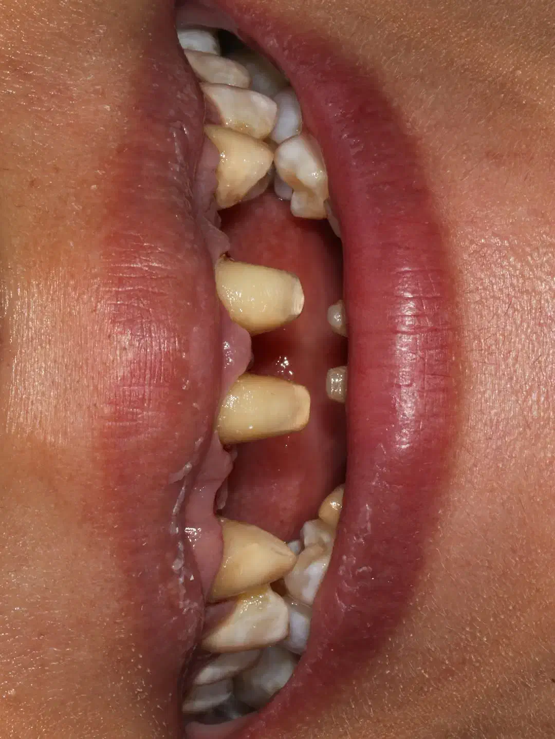 وام دندانپزشکی عصبکشی ایمپلنت .کامپوزیت|خدمات آرایشگری و زیبایی|تبریز, |دیوار