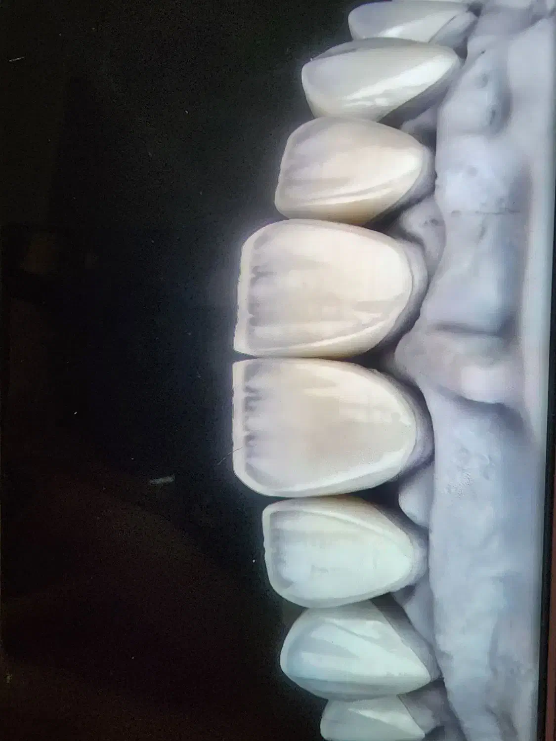 ایمپلنت با روکش 12 میلیون|خدمات آرایشگری و زیبایی|شهرضا, |دیوار