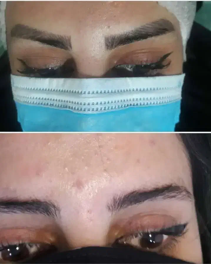 ریموو تتو با لیزر کیوسوییچ|خدمات آرایشگری و زیبایی|خرم‌آباد, |دیوار