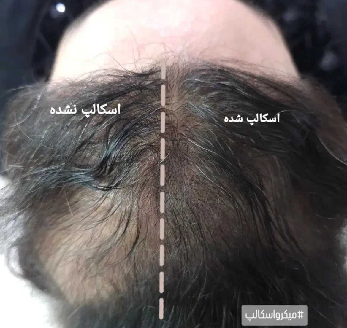 میکرواسکالپ سر|خدمات آرایشگری و زیبایی|جهرم, |دیوار