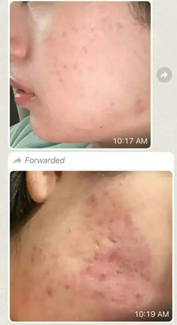 پک ضدجوش وشادابی پوست|آرایشی، بهداشتی، درمانی|نکا, |دیوار