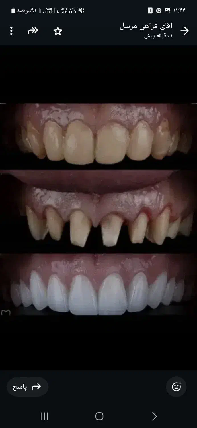 ثبت نام بیمه دندانپزشکی وکامپوزیت وزیبایی دندان|خدمات آرایشگری و زیبایی|گرگان, |دیوار