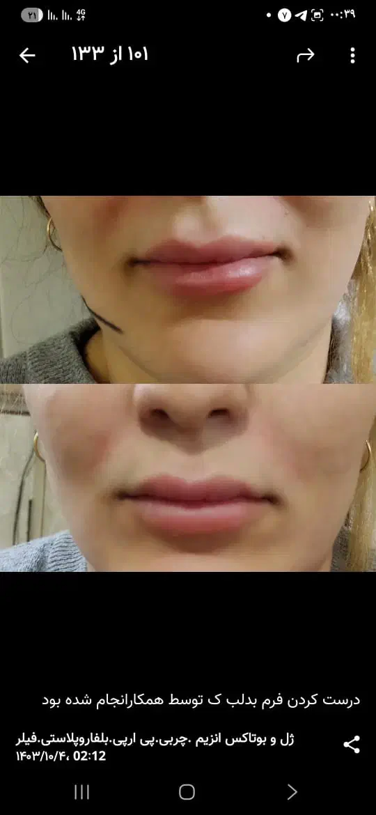 تزریق ژل بوتاکس مزو نخ جوانساز باقیمت مناسب درمنزل|خدمات آرایشگری و زیبایی|شهرضا, |دیوار