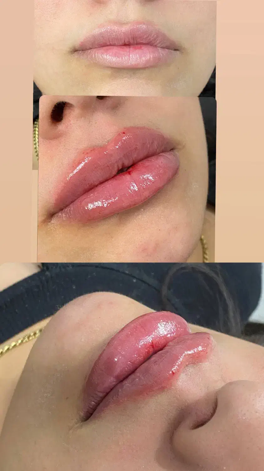 ژل. مزو ژل. جوانساز. بوتاکس|خدمات آرایشگری و زیبایی|کرج, حصارک پایین|دیوار