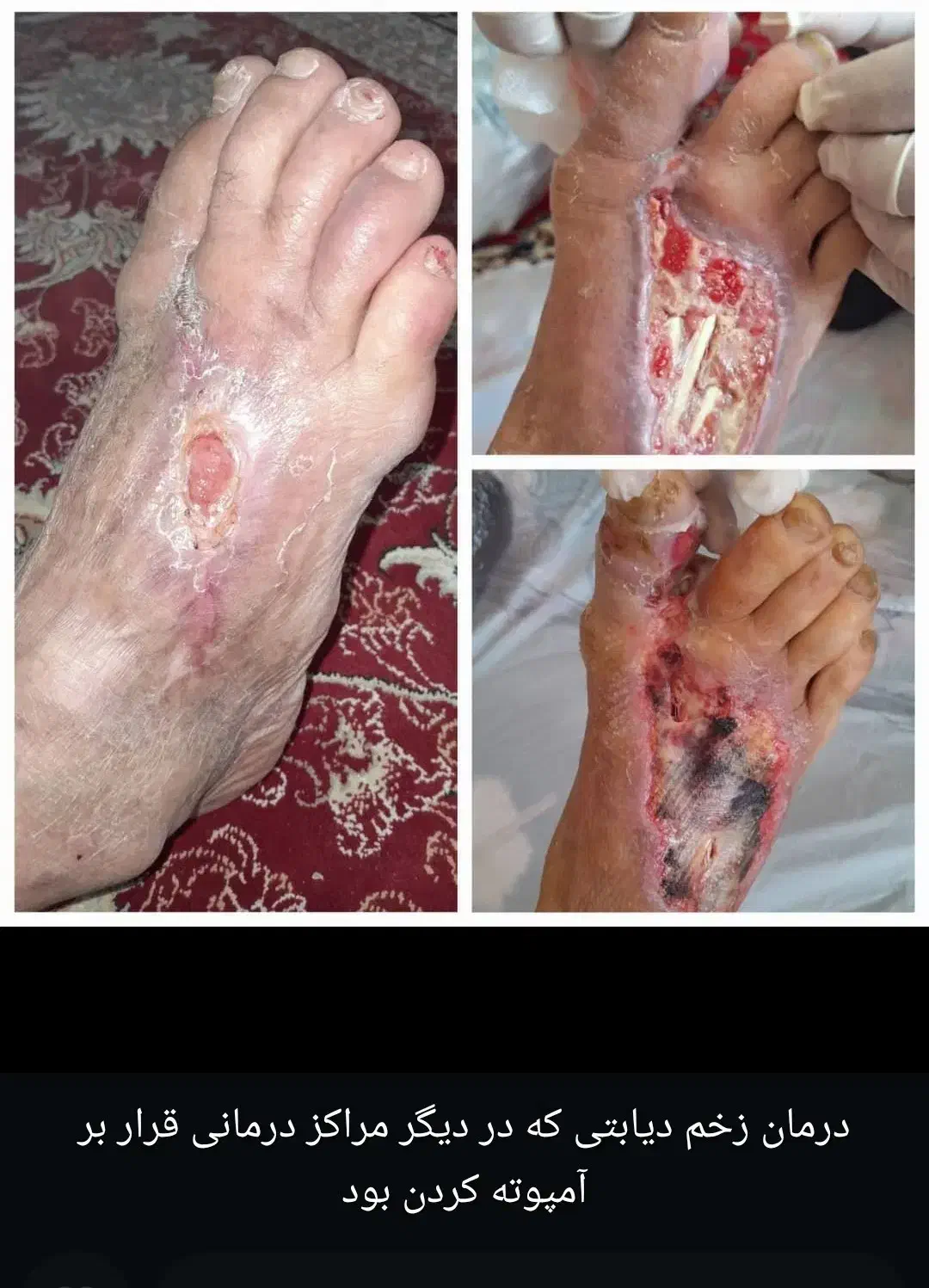 پای دیابتی راقطع نکنید.درمان میشود.|فعالیت داوطلبانه|ایلام, |دیوار