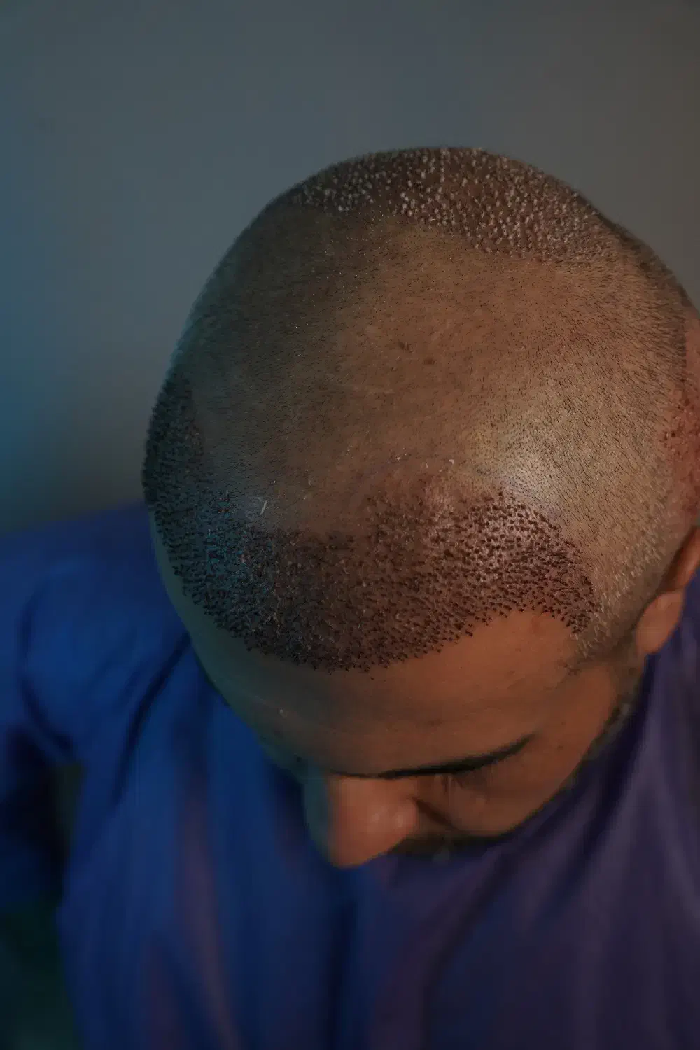 کاشت تخصصی مو به روش FIT|خدمات آرایشگری و زیبایی|رشت, گلسار|دیوار