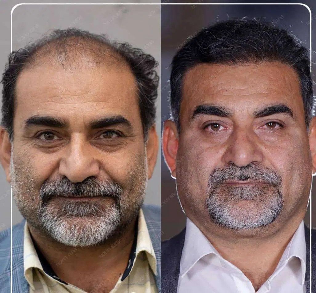 کاشت مو/ابرو/ریش/اقساطی/بدون جراحی|خدمات زیبایی و سلامت|تهران, دربند|دیوار