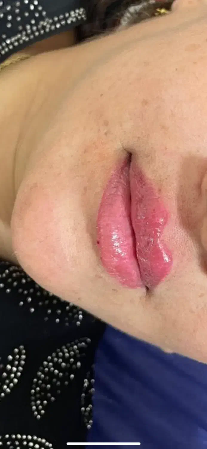 خدمات فیلر و بوتاکس|خدمات آرایشگری و زیبایی|خرمشهر, |دیوار