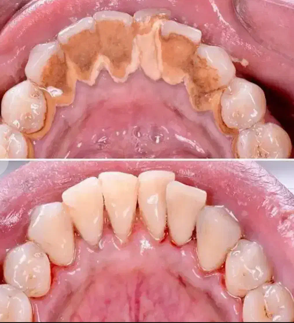 جرم گیری دندان تقریبا رایگان|خدمات آرایشگری و زیبایی|بیرجند, |دیوار