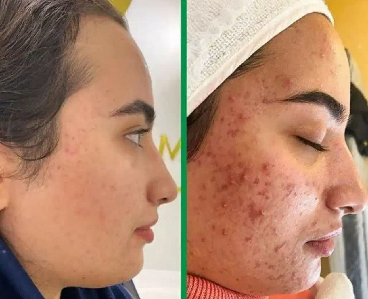 جوان سازی پوست خود را به ما بسپارید|آرایشی، بهداشتی، درمانی|اردبیل, |دیوار