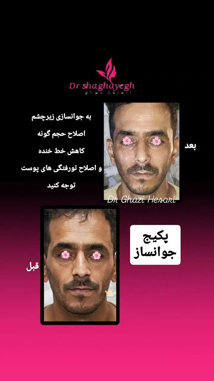 لیزر تزریق بوتاکس ژل فیلر مزوتراپی هایفو توسط پزشک|خدمات آرایشگری و زیبایی|پرند, فاز ۲|دیوار