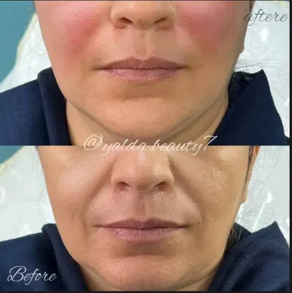 تزریق ژل و بوتاکس|خدمات آرایشگری و زیبایی|بابل, |دیوار