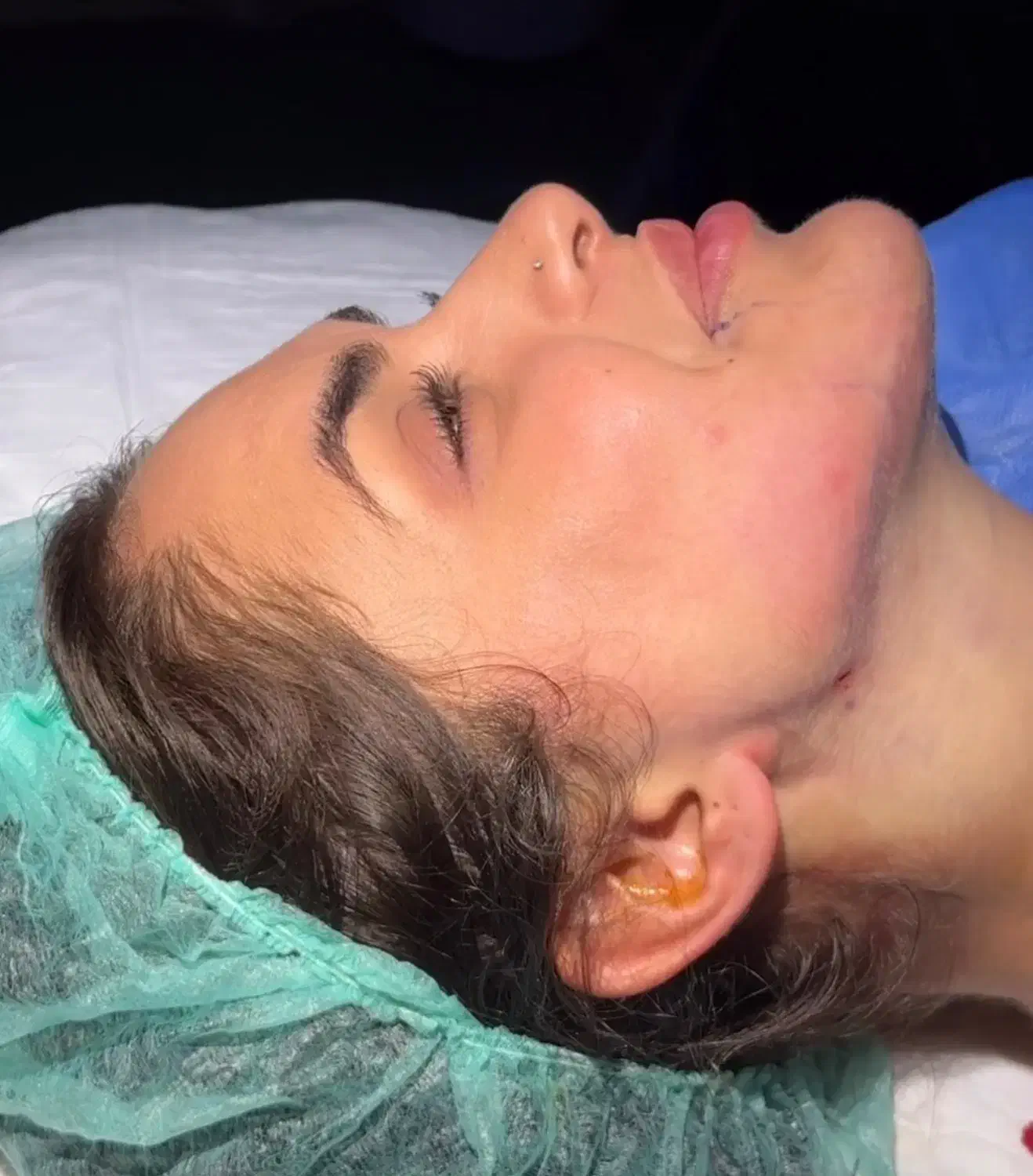 تخلیه چربی غبغب|خدمات آرایشگری و زیبایی|تهران, ایوانک|دیوار