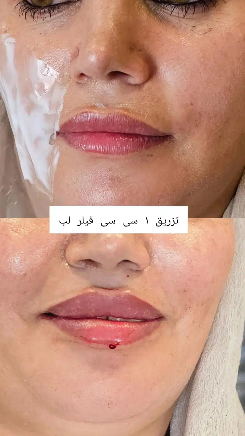 چهره‌ای که عاشقش میشی،بوتاکس،ژل وفیلر توسط متخصص|خدمات آرایشگری و زیبایی|ارومیه, |دیوار