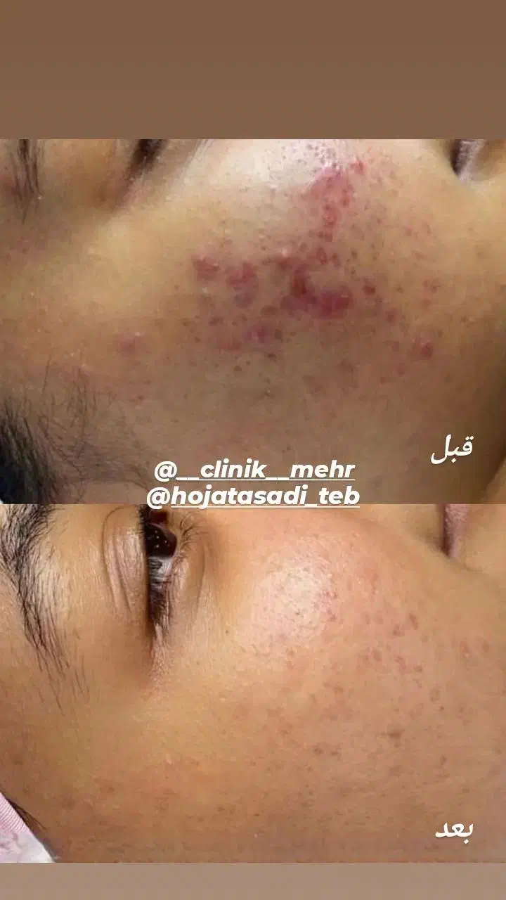 پاکسازی پوست وفیشیال|خدمات آرایشگری و زیبایی|مسجد سلیمان, |دیوار