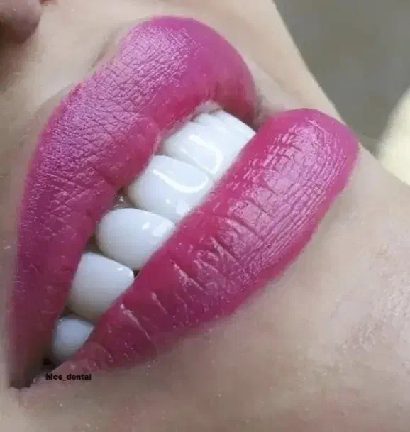 عصب کشی کامپوزیت|خدمات آرایشگری و زیبایی|بروجرد, |دیوار