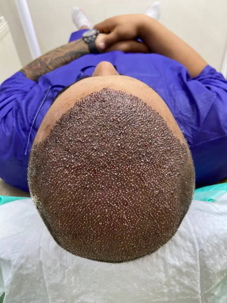 کاشت مو فقط با پرداخت ۱۰ میلیون|خدمات آرایشگری و زیبایی|تهران, جردن|دیوار