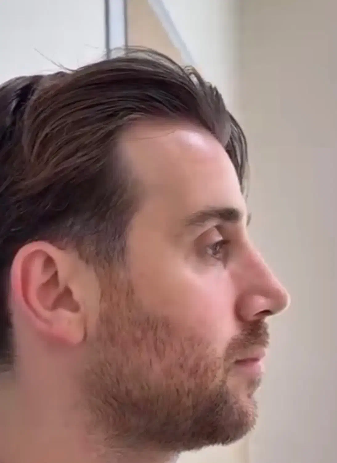 جشنواره عمل بینی ابدو لیفت لیپو ساکشن پیکر تراشی|خدمات آرایشگری و زیبایی|بومهن, |دیوار