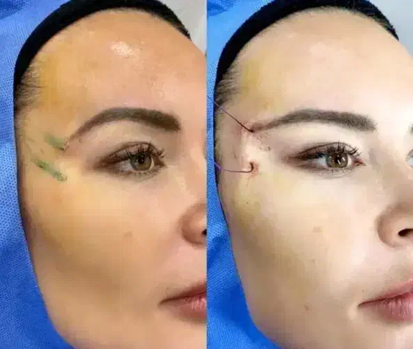 ژل و بوتاکس کاشت ابرو قسطی|خدمات آرایشگری و زیبایی|یاسوج, |دیوار