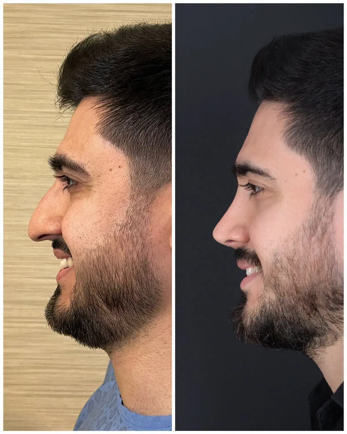 جراحی،زیبایی،بینی|خدمات آرایشگری و زیبایی|خرم‌آباد, |دیوار