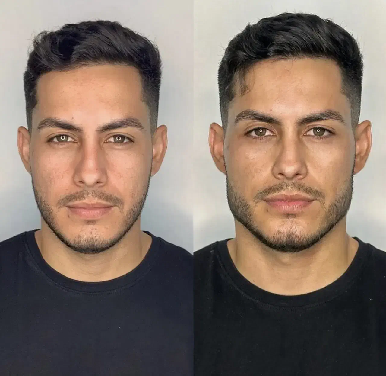 تخفیف خدمات مدلینگ فیلر بوتاکس مزوژل خانم و آقا|خدمات آرایشگری و زیبایی|تهران, پاسداران|دیوار