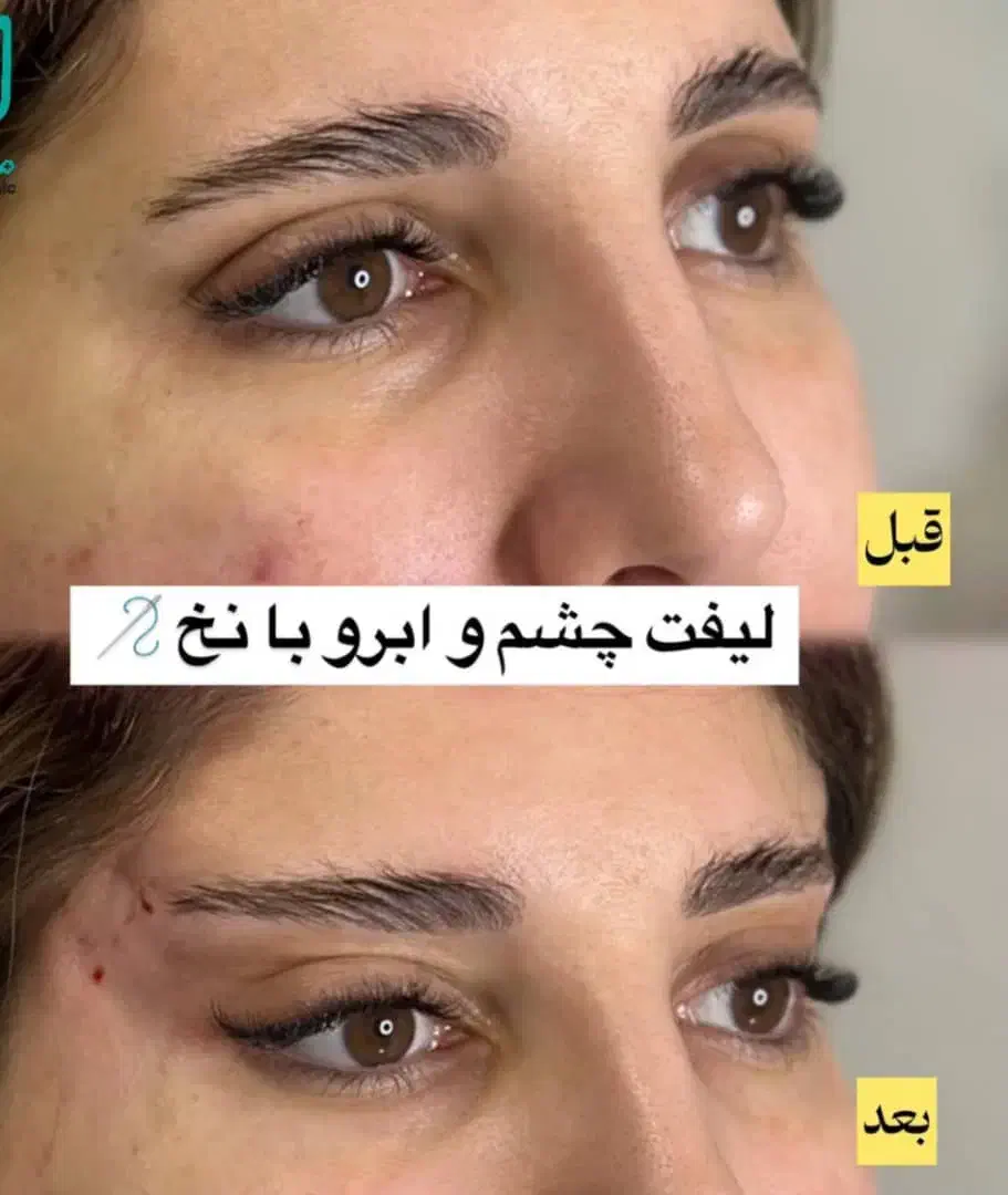 مطب پزشک.ژل وبوتاکس.لیفت بانخ.فیلربینی ژل آلت|خدمات آرایشگری و زیبایی|قم, دورشهر|دیوار