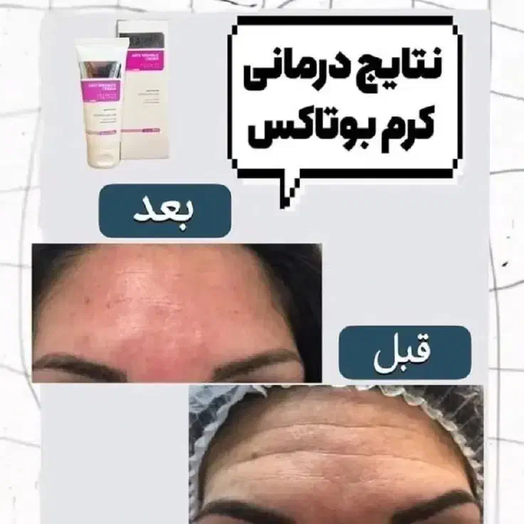 کرم ۵کاره گاتیو جایگزین بوتاکس|آرایشی، بهداشتی، درمانی|گنبد کاووس, |دیوار