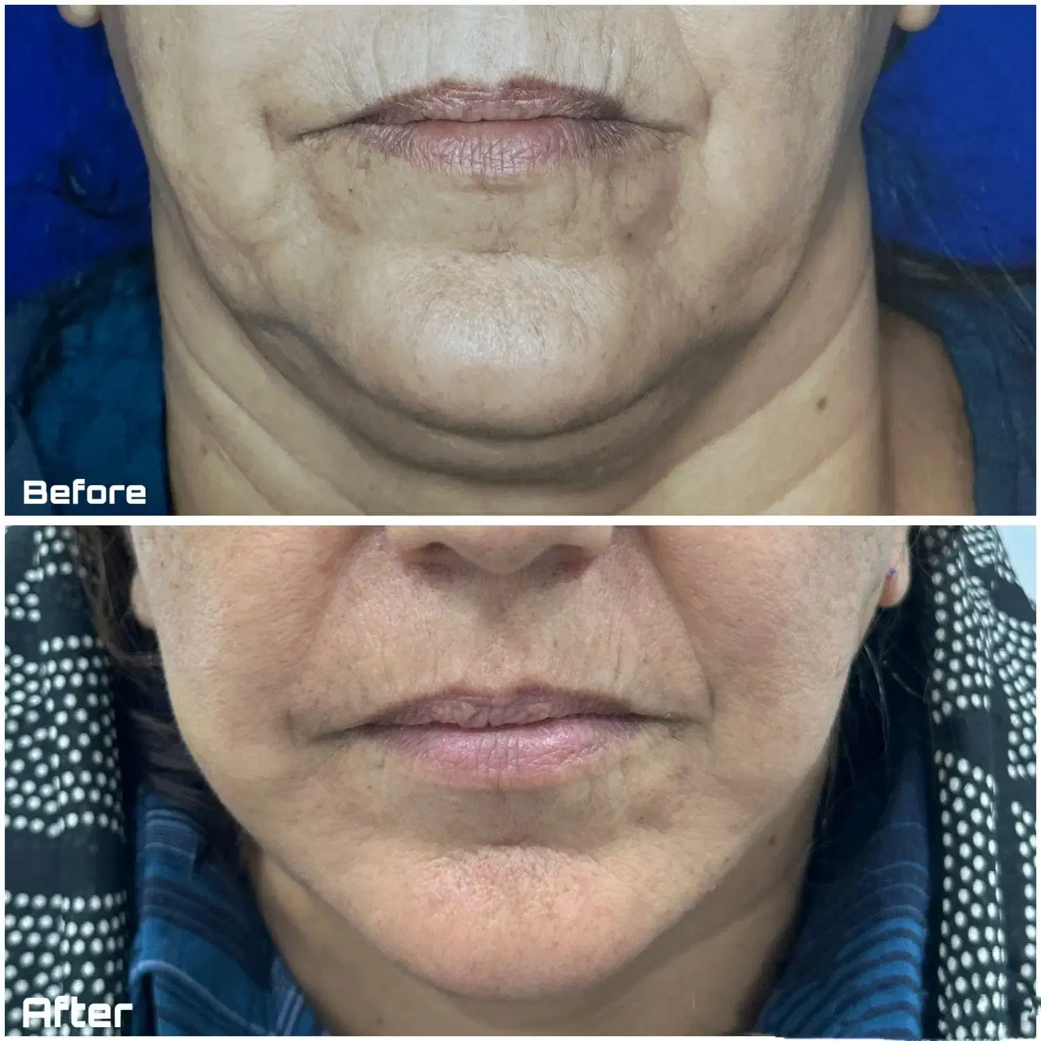 جراحی لیفت صورت در شیراز ماندگاری بالا+اقساط|خدمات آرایشگری و زیبایی|شیراز, فرهنگ شهر|دیوار