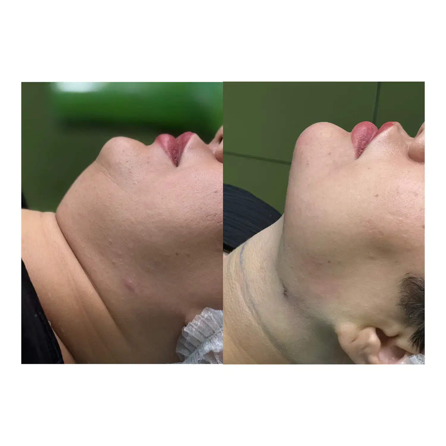 ساکشن غبغب،جراحی بلفاروپلاستی|خدمات آرایشگری و زیبایی|شهرکرد, |دیوار