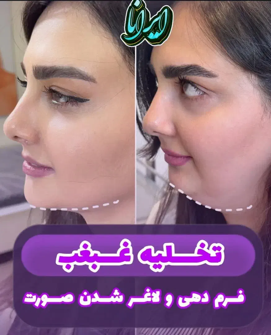 ساکشن غبغب توسط جراح (کلنیک ایرانا)|خدمات آرایشگری و زیبایی|یاسوج, |دیوار